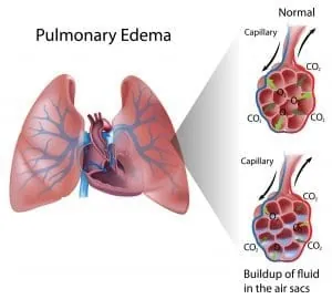 Tous savoir sur œdème pulmonaire de haute altitude (OPHA)